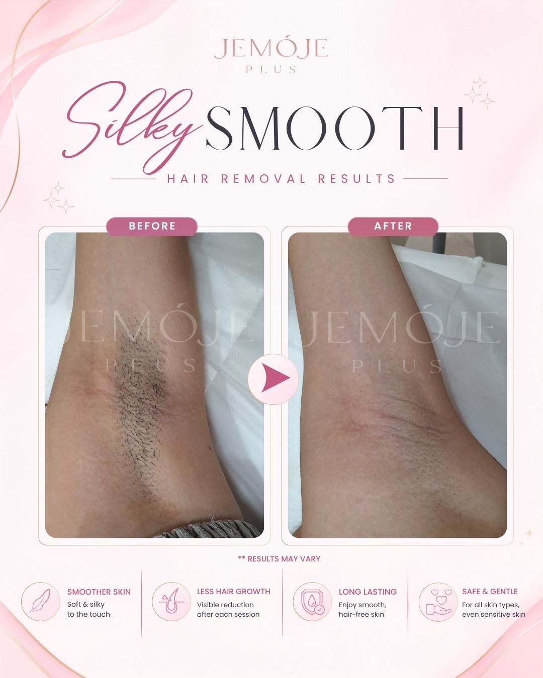 SPECTRA 4 Hair Removal before and after result 1 at JEMOJE Plus Mid Valley Kuala Lumpur