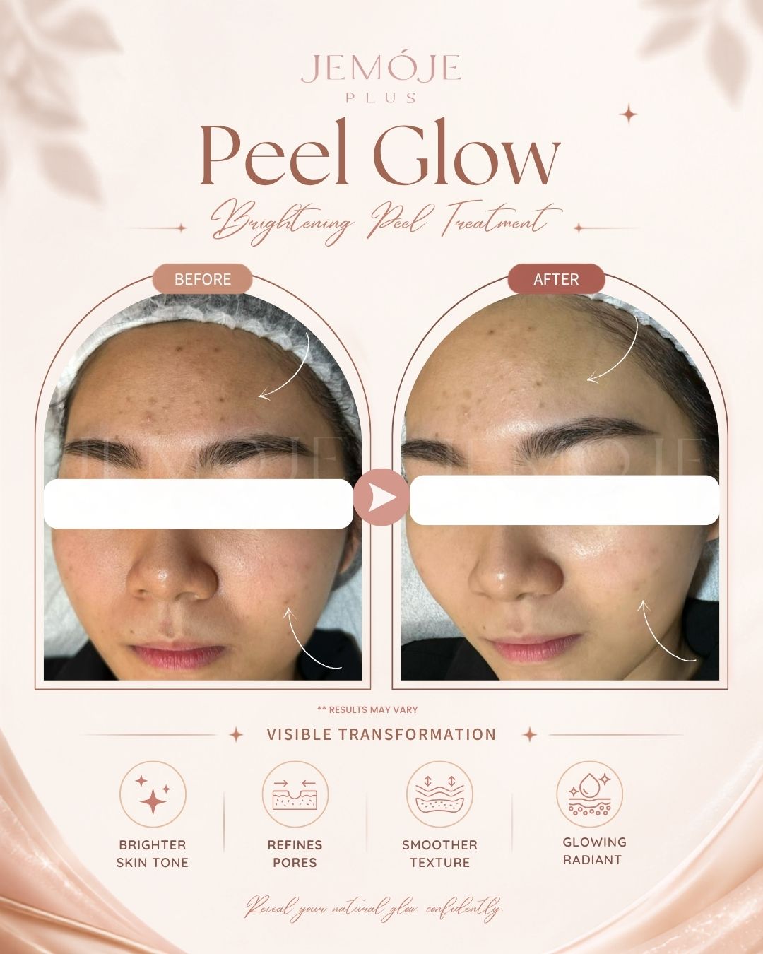 Peel Glow Treatment before and after result 2 at JEMOJE Plus Mid Valley Kuala Lumpur