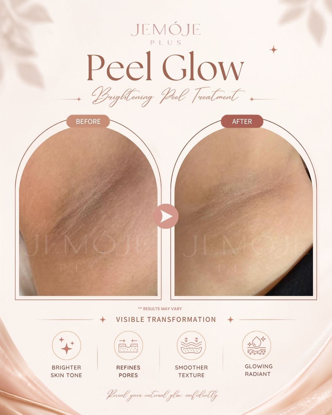 Peel Glow Treatment before and after result 3 at JEMOJE Plus Mid Valley Kuala Lumpur
