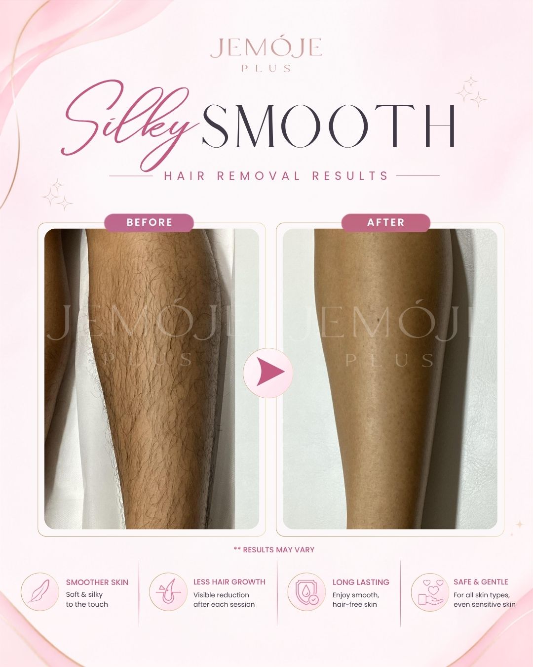 SPECTRA 4 Hair Removal before and after result 2 at JEMOJE Plus Mid Valley Kuala Lumpur