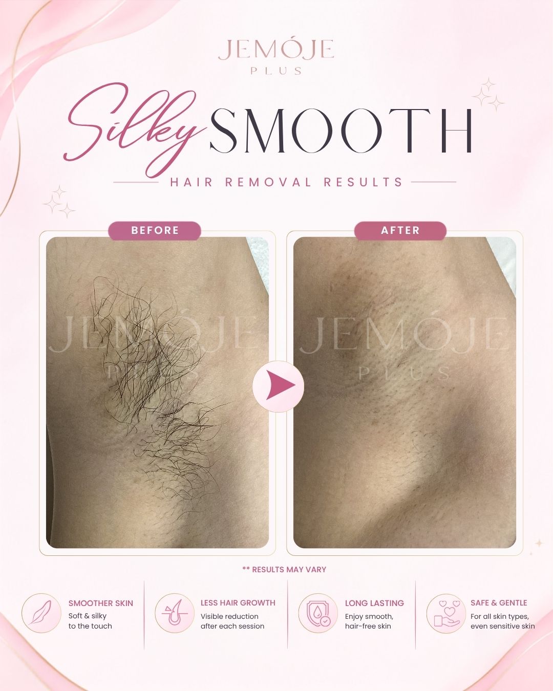 SPECTRA 4 Hair Removal before and after result 3 at JEMOJE Plus Mid Valley Kuala Lumpur