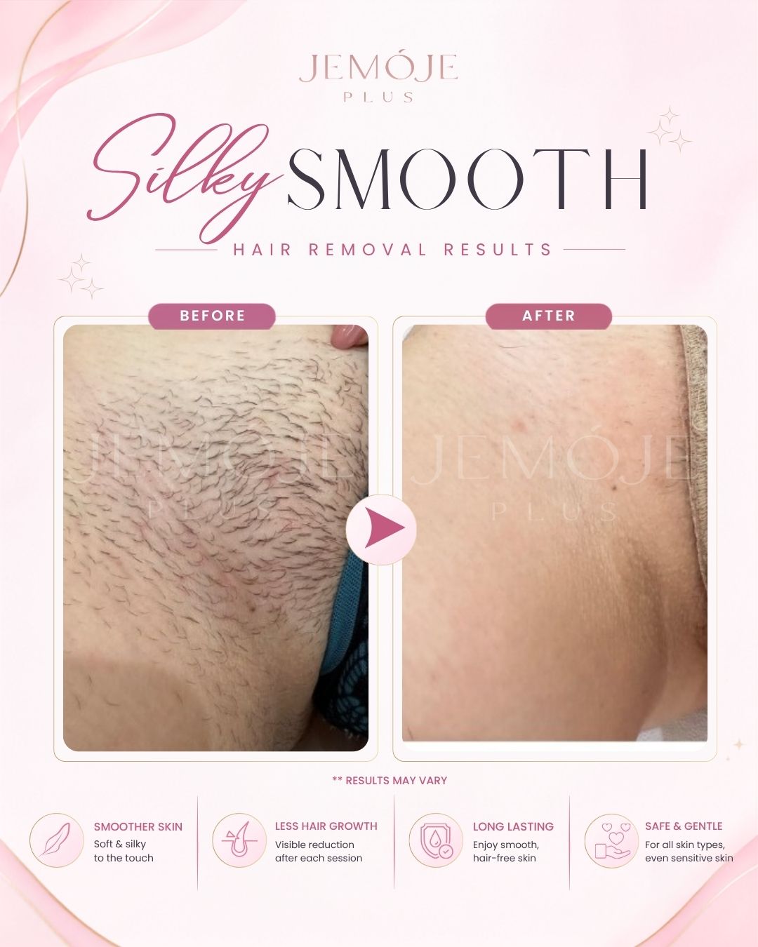 SPECTRA 4 Hair Removal before and after result 4 at JEMOJE Plus Mid Valley Kuala Lumpur