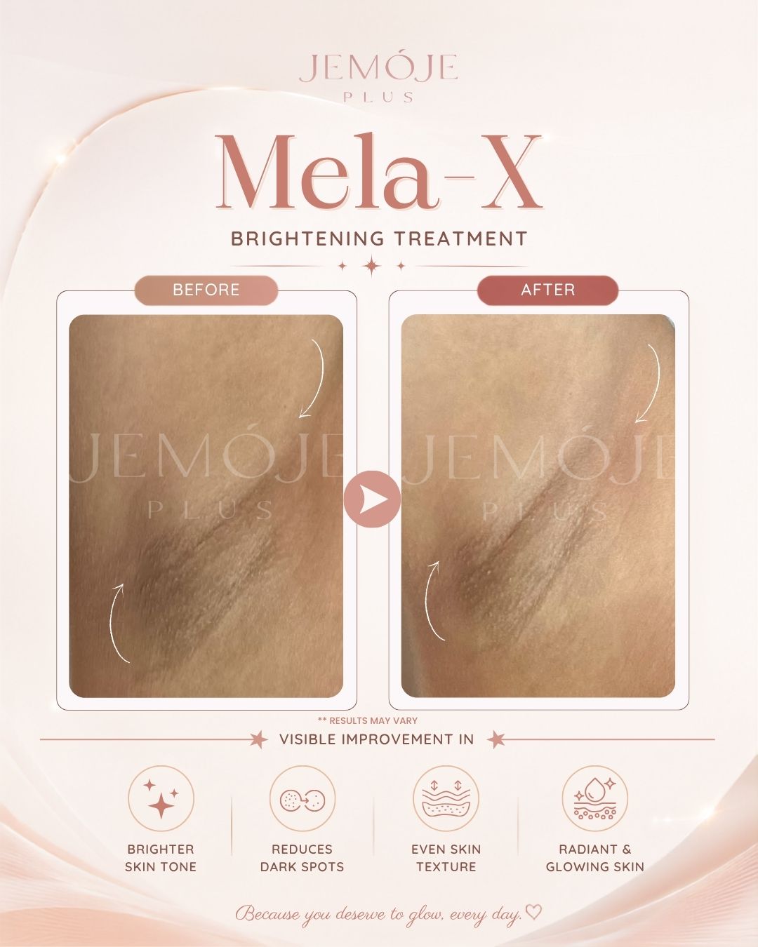 Mela-X Skin Brightening before and after result 2 at JEMOJE Plus Mid Valley Kuala Lumpur