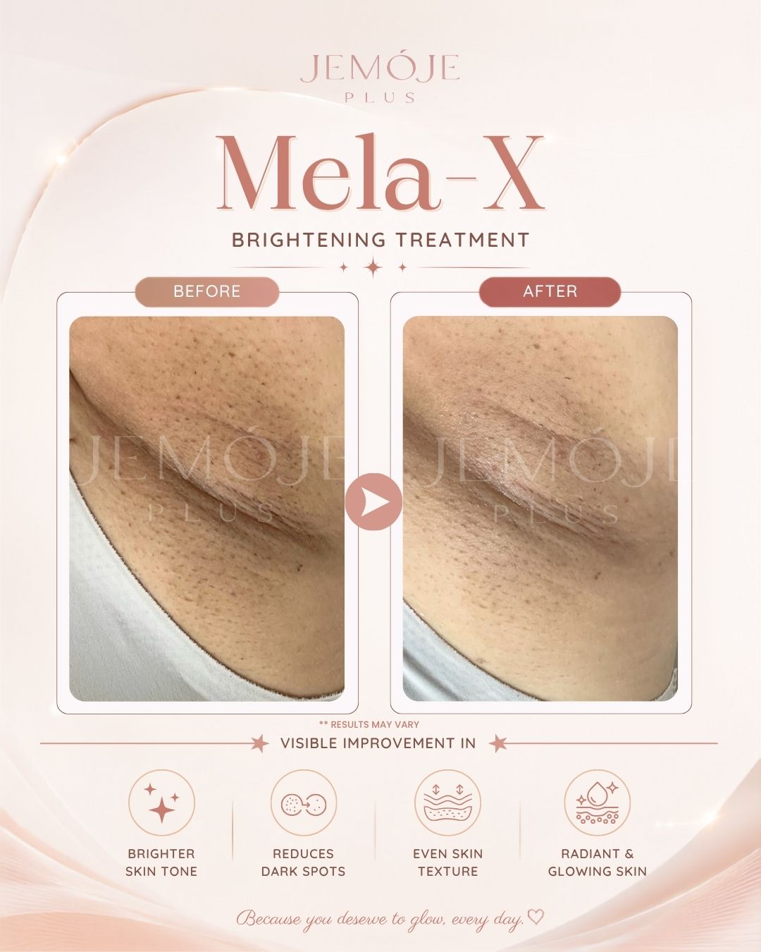 Mela-X Skin Brightening before and after result 3 at JEMOJE Plus Mid Valley Kuala Lumpur